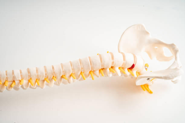 istock Lumbar spine displaced herniated disc fragment, spinal nerve and bone. Model for treatment medical in the orthopedic department. 2157427755