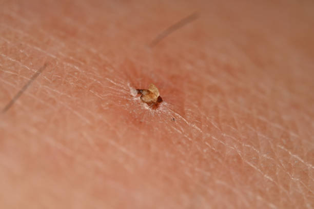 istock close-up of a scab on skin 2157440498