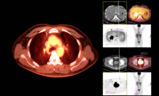 istock A PET CT scan image shows comprehensive views of organs and tissues. 2157644776