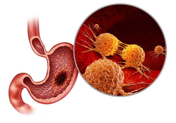 Human Stomach Cancer