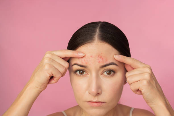istock Young woman upset looking at the camera and showing pimples on her forehead. 2157828593