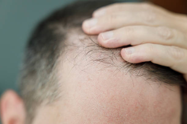 istock Middle aged man checking his bald spots in the mirror 2157845010