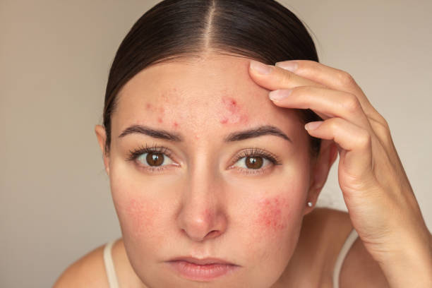 istock Young caucasian woman looking at camera and examines pimples on her forehead. 2157945257