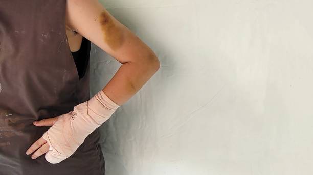 istock Wound and Bruises on the arm. 2158093502