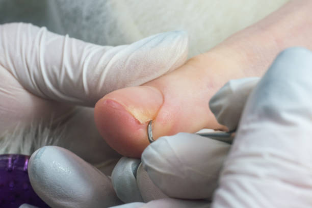 istock Podologist uses a curette to remove a callus on the toe 2158165230