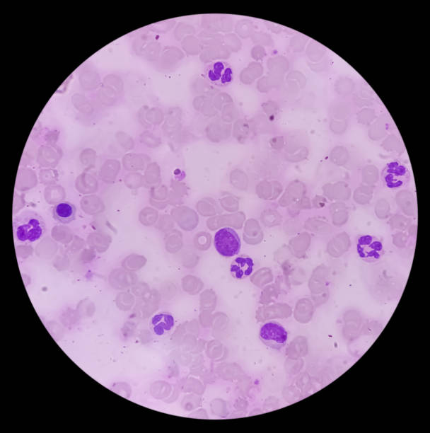 istock Bone marrow study (BMS).Panmyelosis. Myeloproliferative disorder. Acute myeloid leukemia. 2158186103