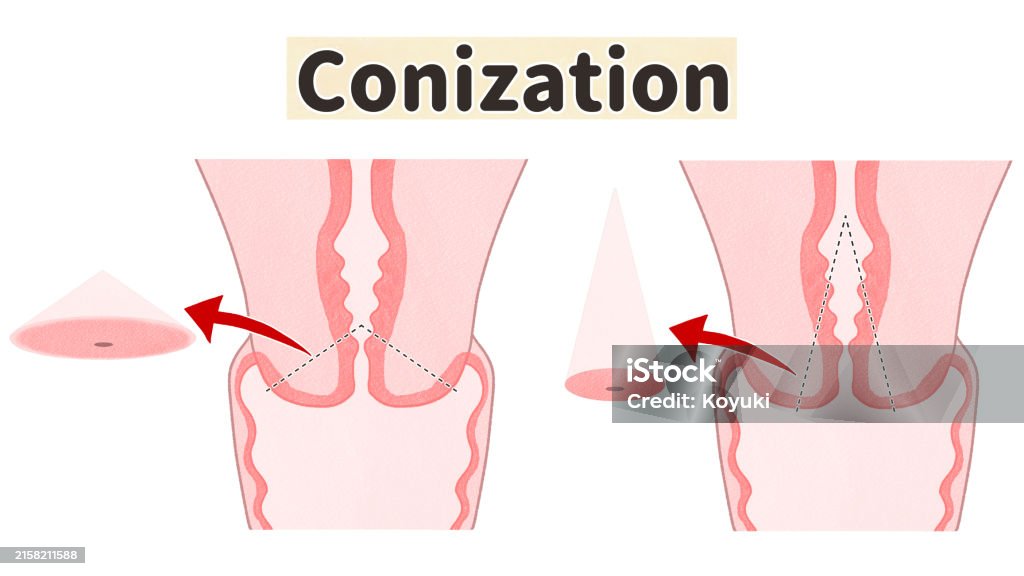 Conization Definition Cervical Conization Diagram Stock Illustration - Download Image Now ...