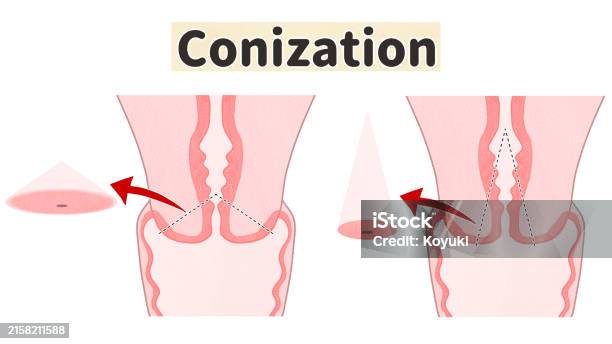 Conization Meaning Cervical Conization Diagram Stock Illustration - Download Image Now ...