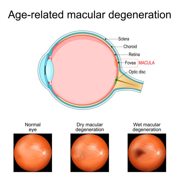 istock Age-related macular degeneration. Cross section of human eye 2158776002