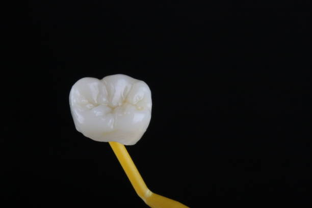 corona dental de cerámica de circonio - corona-dental fotografías e imágenes de stock