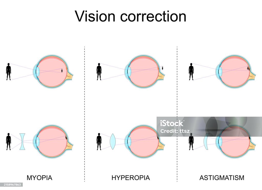 Hyperopia Vision Examples Vision Defects Myopia Hyperopia Astigmatism Vision Correction Stock ...