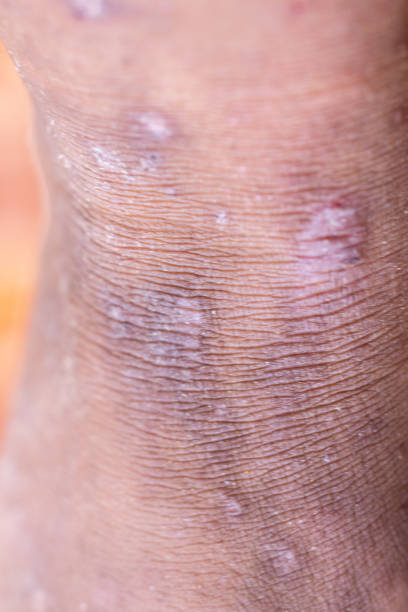 Lu's Rash 90+ Lupus Skin Rash Stock Photos, Pictures & Royalty-Free Images - iStock