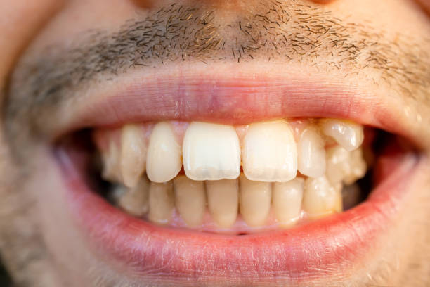 istock Close up of young man's face with crooked teeth. Teeth before install braces. Teeth need ortodonti. 2159316202