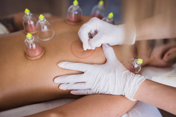 istock Close-up of a therapist using needle during cupping therapy 2159398367