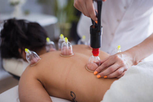 Therapist performing blood suction with cups Patient having a hajamat therapy performed at therapist's office cupping therapy stock pictures, royalty-free photos & images