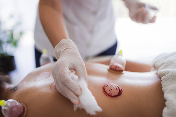 istock Therapist cleaning after hijama therapy 2159398598