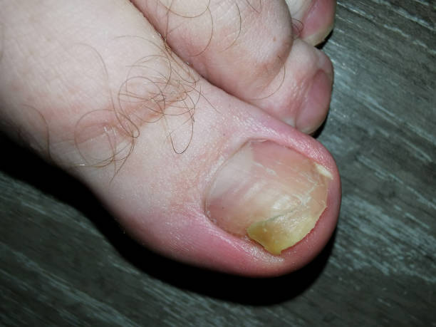 istock nail fungus as human medical problem 2159624995
