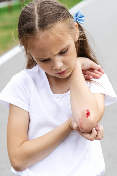 istock A girl with a wound on her elbow fell from a scooter 2159630350