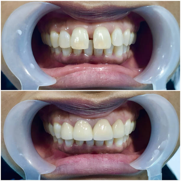 istock Before and after treatment for large gap between the front teeth or incisors, known as diastema 2159807861