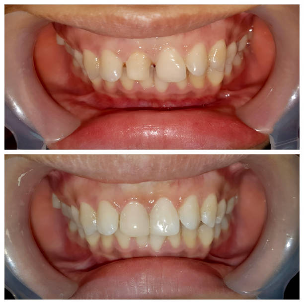 istock Before and after restoration for large gap between the teeth, known as diastema 2159899083