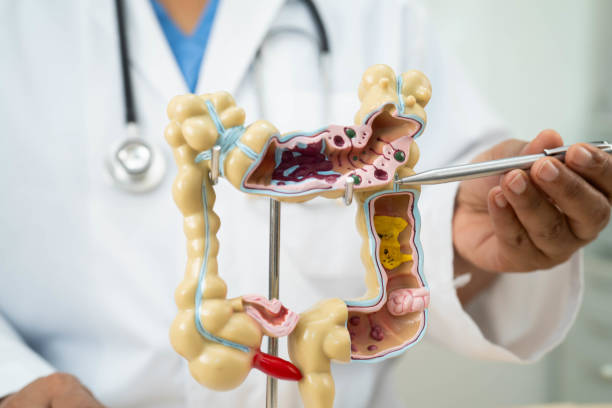 istock Ulcerative Colitis. Intestine, appendix and digestive system, doctor holding anatomy model for study diagnosis and treatment in hospital. 2159949952
