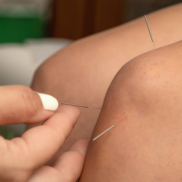 istock Acupuncture treatment for knee mobility improvement 2160196817
