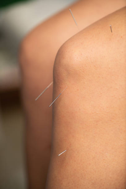 istock Acupuncture therapy  for reducing inflammation in the knee joint 2160196854