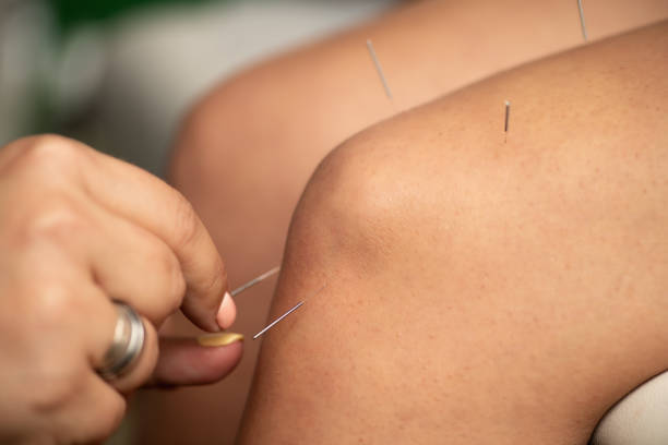 istock Acupuncture therapy  for reducing inflammation in the knee joint 2160196871