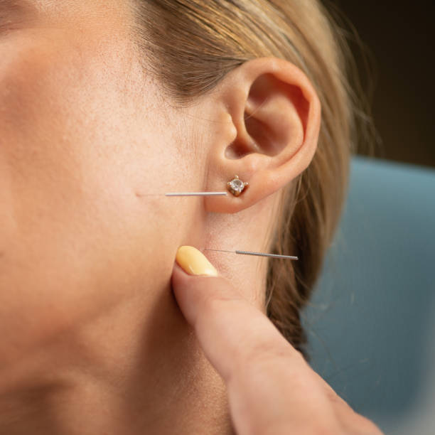 istock Acupuncture treatment for Bell's palsy 2160198865