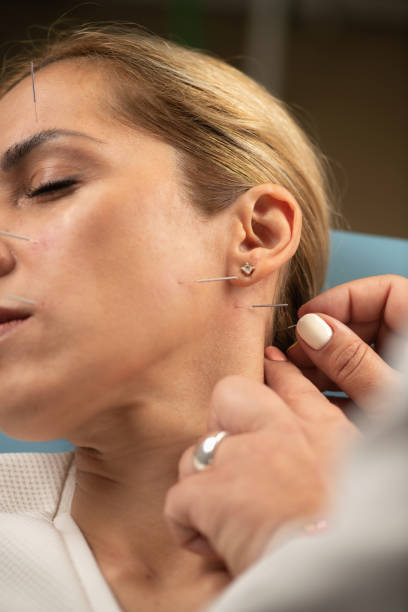 istock Neuro acupuncture treatment on female patient face 2160198955