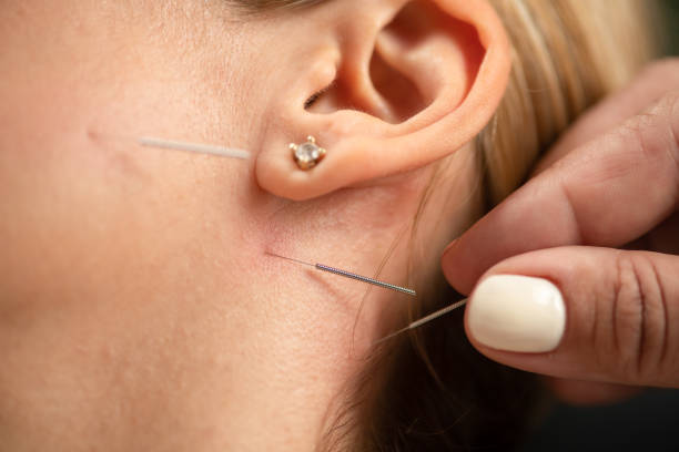 istock Acupuncture Treatment for facial spasms 2160199018