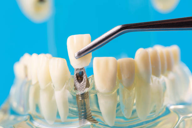 A dental crown made of metal ceramics in tweezers against the background of a medical model of the dental jaw. The concept of making dental crown molds for a patient s tooth from different alloys. Orthodontics in dentistry. una corona dental hecha de cerámica metálica en pinzas sobre el fondo de un modelo médico de la mandíbula dental. el concepto de hacer moldes de coronas dentales para el diente de un paciente a partir de diferentes aleaciones. ortodoncia en odontologí