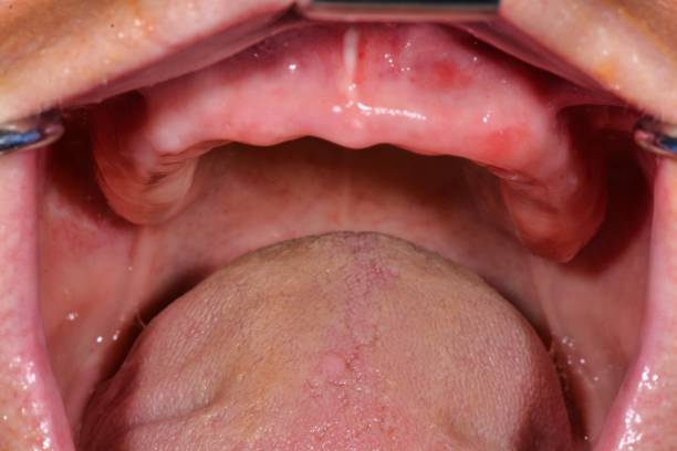 istock Close-Up View of a Persons Mouth With Dentures 2160424175