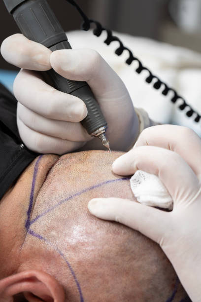istock Comprehensive Hair Transplant Procedure: From Preparation to Post-Op Results 2160426348