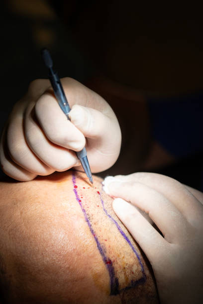 istock Comprehensive Hair Transplant Procedure: From Preparation to Post-Op Results 2160426425