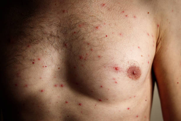 istock Close-up a man torso front who having varicella blisters or chickenpox or Monkeypox. New virus dangerous over the world 2160486787