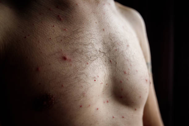 istock Man chest front who having varicella blisters or chicken pox or monkey pox 2160486794