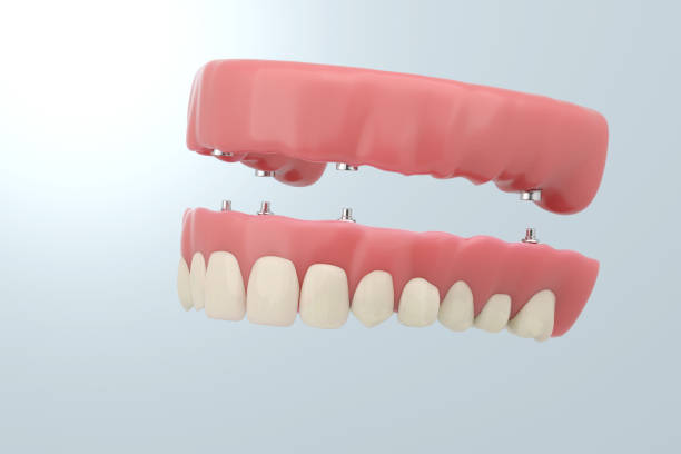 istock Full mouth dental implant 2160596935