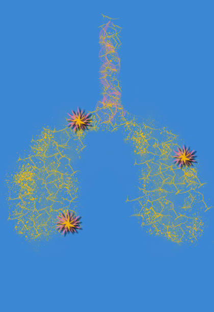 istock Infected lungs concept, tuberculosis mycobacterium infection presence, bacterial tuberculosis, lung cancer and lung disease, tuberculosis Department samples in the lab 2160696688