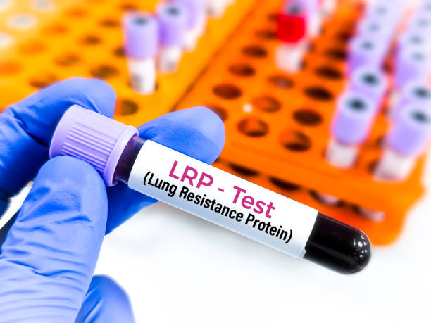 istock Blood sample for Lung Resistance Protein (LRP) test, to diagnose Chronic myeloid leukemia (CML). 2160728446