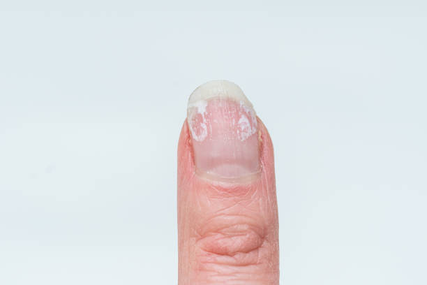 istock woman's finger with bitten and broken nails without manicure with overgrown cuticle and a damaged nail plate 2160843631