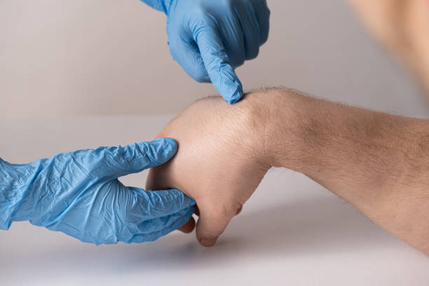 gangliová cysta nebo hygrom zápěstí na ruce pacienta mužského pohlaví, vyšetření lékařem - ganglion - stock snímky, obrázky a fotky