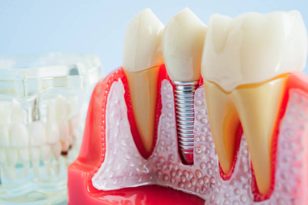 istock Artificial tooth roots dental implant into jaw, Root canal model for dentist. 2161116785