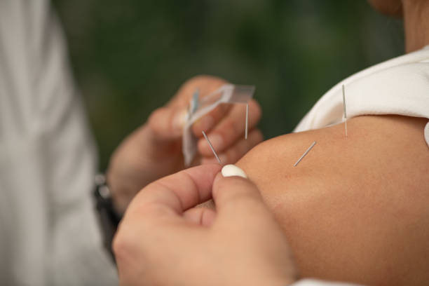 istock Acupuncture Treatment for Shoulder Pain and Rotator Cuff Injuries 2161299881