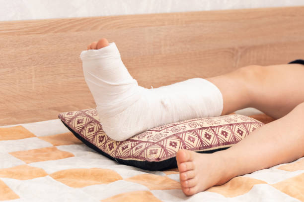 istock Children's legs, one leg is broken and in a cast 2161370712