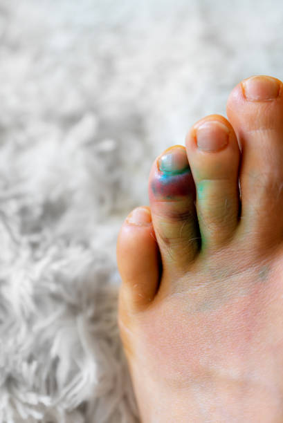 istock Male leg with a bruise on the toe. 2161373289