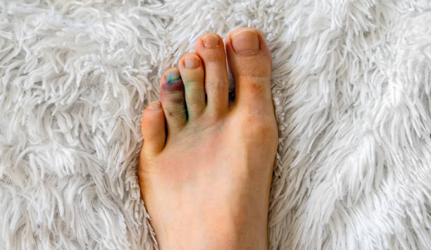 istock Male leg with a bruise on the toe. 2161373888