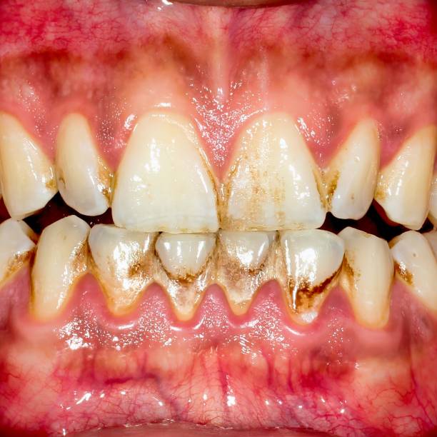 istock Close-Up of Teeth With Brown Stains 2161433580