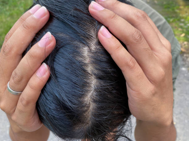 istock man have a dandruff and hair loss 2161450130