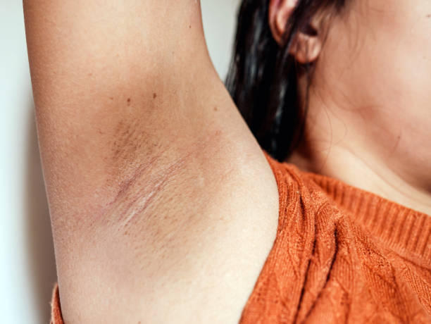 istock Close-up of Women armpit with problem black armpit. Dark and wrinkle armpit from deodorant allergic. 2161610951